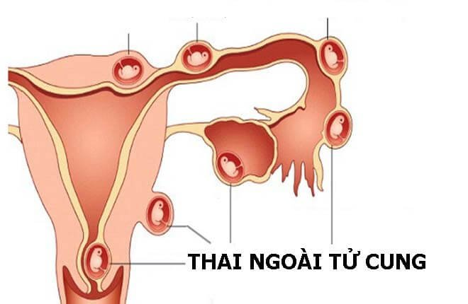  Tiếp xúc với khói thuốc lá làm tăng nguy cơ mang thai ngoài tử cung